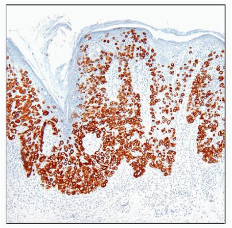 Stages Of Pagets Disease Skin