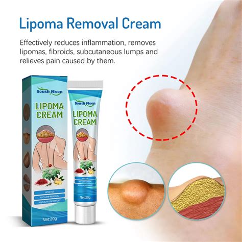 Ubat Benjolan Lipoma Removal Cream South Moon Benjolan Swelling