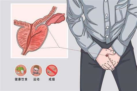 成都中医肿瘤医院段心好：前列腺癌术前术后护理注意事项 知乎