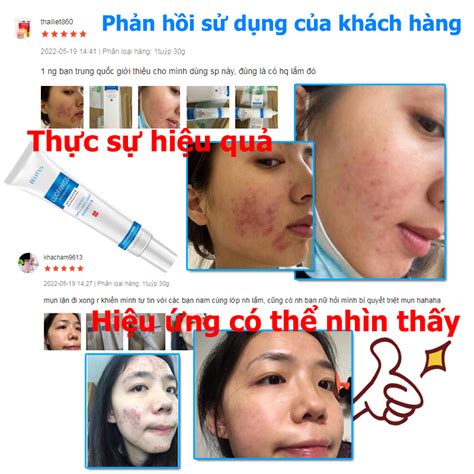 Mua Kem Thâm Mụn 30g Gel Ngừa Mụn Dưỡng ẩm Làm Sáng Da Làn Da Mịn Màng