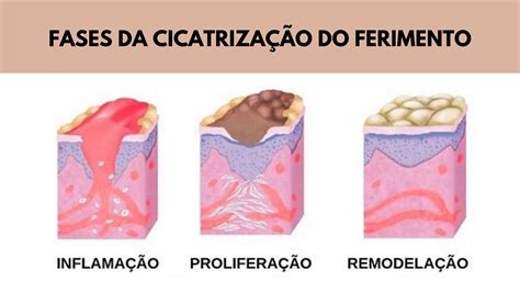 Fases Da Cicatrização De Feridas