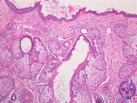 15 Female Genital Organs 9 Ovarian Teratoma Dermoid Cyst Pathology