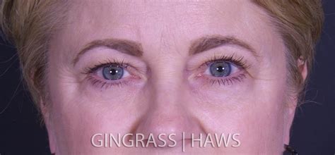 Eyelid Lift Case 2693 - The Plastic Surgery Center of Nashville