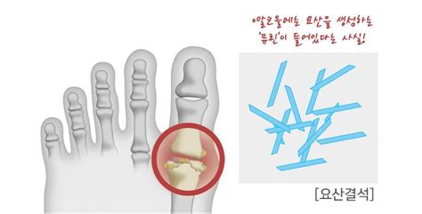 통풍성 관절염 유발하는 나쁜 조합 헬스코리아뉴스