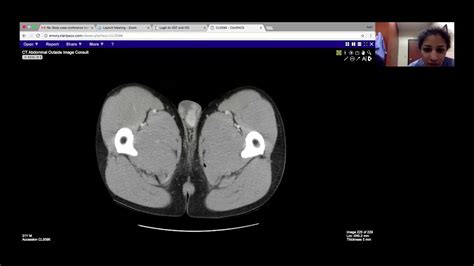 Aarti Sekhar Emory Bilateral Testicular Masses On Testis Youtube