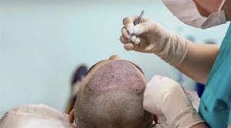 Things To Consider During FUE Hair Transplant Tat Hit