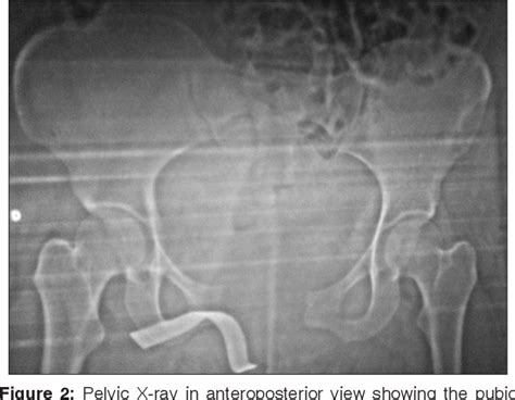 Figure 2 From Intrapartum Pubic Symphysis Disruption Semantic Scholar