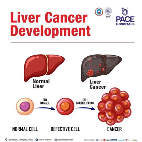 Liver Cancer Symptoms Causes Types Complications Prevention