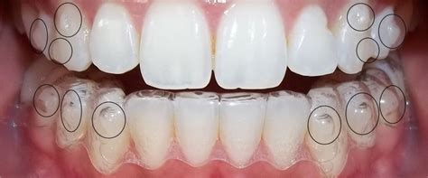 Qu Son Los Ataches En Invisalign Cl Nica Dental Trejo