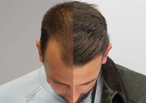 What Are The Best Hair Loss Treatments