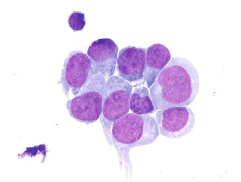 Cerebrospinal Fluid Csf Cytology Springerlink