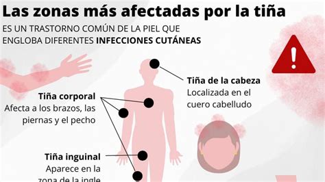 Qué es la tiña y qué hacer si estás contagiado