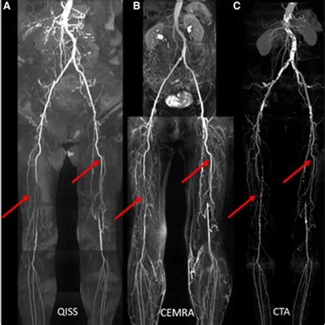 Mri Angiography Right Lower Limb Test Near You In Delhi Book Test At