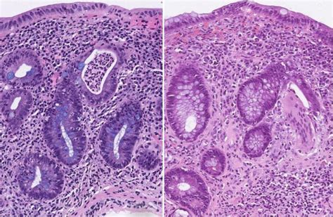 Histomorphological Diagnosis Of Ulcerative Colitis And Associated Conditions Intechopen