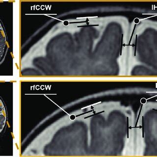 Schematic diagram of the procedure for subarachnoid space width... | Download Scientific Diagram