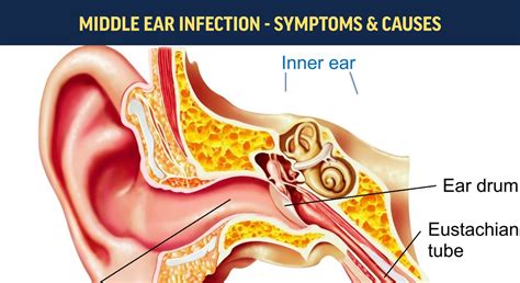 Inner Ear Infection