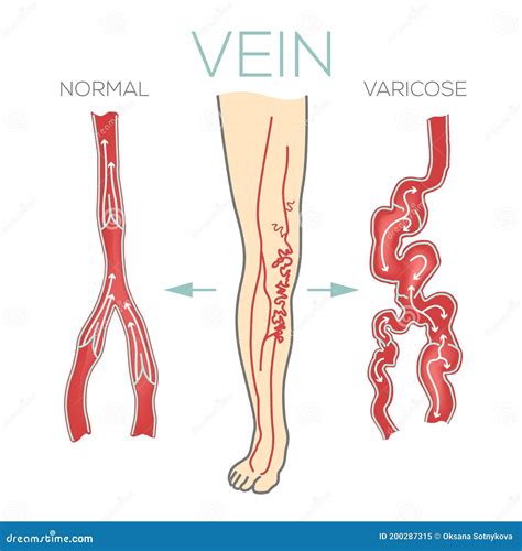 Varicose Veins, Large, Swollen Vein on the Legs and Feet. Medical