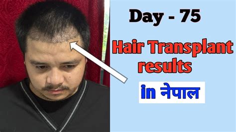 Day 75 My My Hair Transplant Results Hair Transplant In Nepal