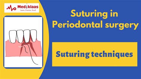 Suturing In Periodontal Surgery L Suturing Techniques L Wound Suturing