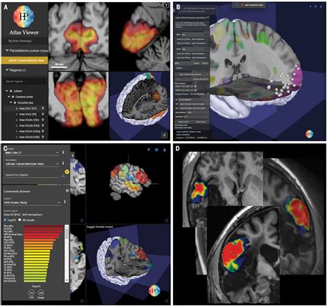 Julich Brain A 3D Probabilistic Atlas Of The Human Brains