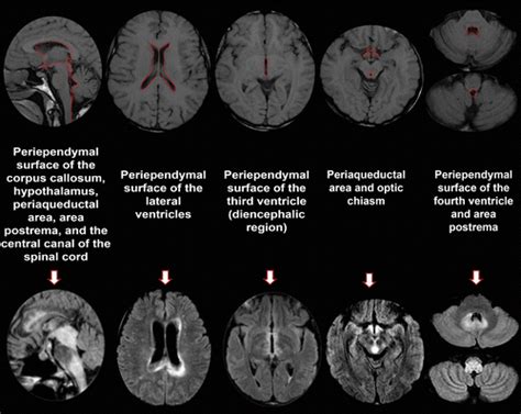 Neuromyelitis Optica Spectrum Disorders Spectrum Of Mr Imaging Findings And Their Differential