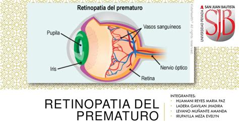 Retinopatia Del Prematuro Terminado Nicole Medina V Squez Udocz