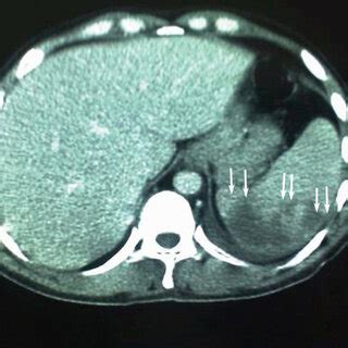 Computed Tomography Of The Patient Demonstrating Splenic Infarcts