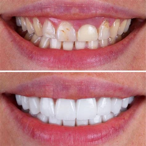 Porcelain Veneers On Harley Street Pro Dental Clinic