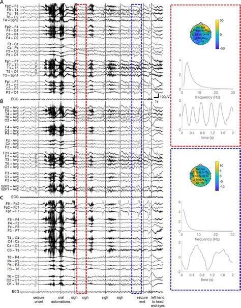 Thirtysecond EEG Trace Showing The Ictal Evolution During A Nocturnal