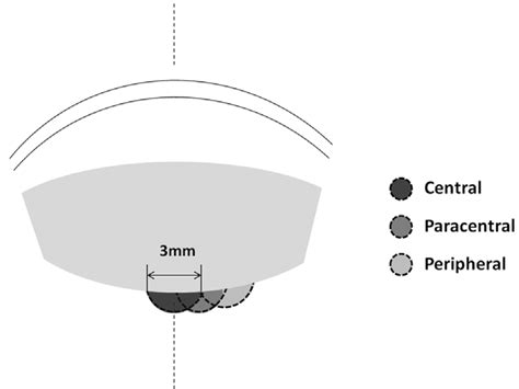 Classification Patterns Of The Different Cataract Locations Download