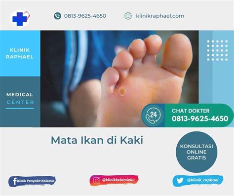 Mata Ikan Di Tangan Dan Kaki Penyebab Dan Cara Mengobatinya