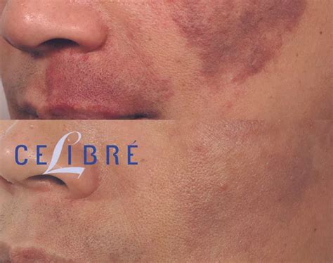 The Ultimate Guide to Laser Port Wine Stain Birthmark Removal