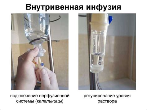 Внутривенное капельное введение растворов: выбор системы и проведения ...