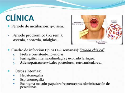 Mononucleosis Infecciosa