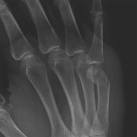 Boxer Fracture Image Radiopaedia Org