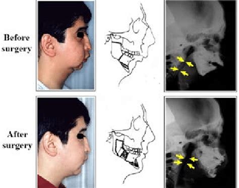 A Patient With Sleep Disordered Breathing Due To Micrognathia Related Download Scientific