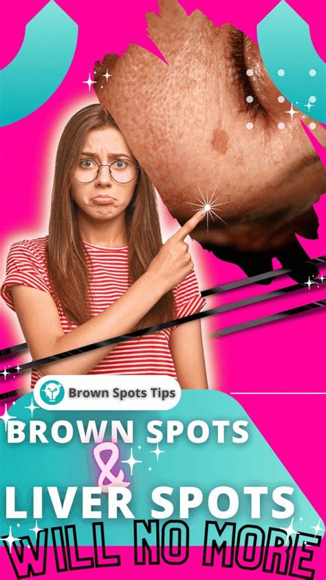 Here Is The Best Solution For Brown Spots Brown Spots On Skin, Dark ...