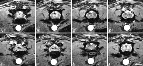 In Vivo High Resolution Mr Imaging Of Neuropathologic Changes In The