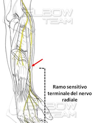 Sindrome Da Compressione Del Nervo Radiale Il Gomito