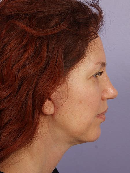 Los Angeles Facelift Before And After Photos Beverly Hills Plastic