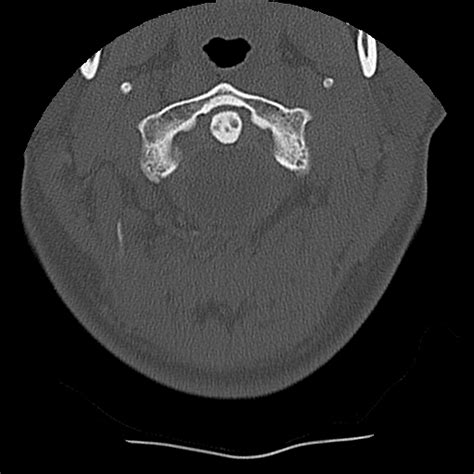 File Normal Trauma Chest Pelvis And Spine Imaging Radiopaedia