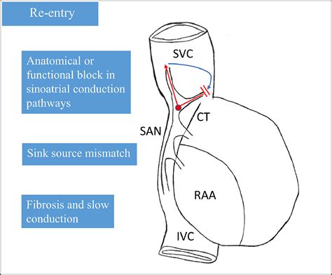 Targeted Treatment Of Inappropriate Sinoatrial Node Tachycardia Based