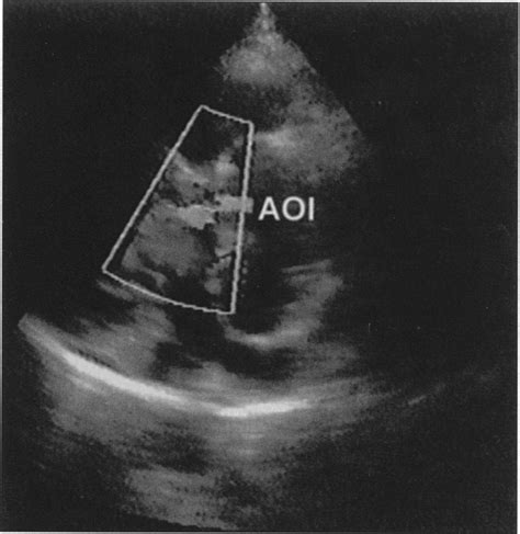 Echocardiography Showing The Associated Aortic Incompetence Aoigrade