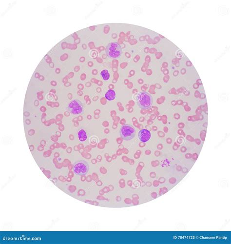 Leukemia Blood Smear Vs Normal Blood Smear