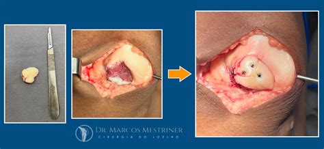 Lesão Condral e Osteocondral do Joelho Lesão de Cartilagem