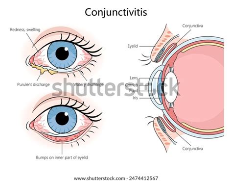 3,645 Conjunctivitis Symptoms Royalty-Free Photos and Stock Images ...