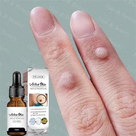 Effective Remover Wartswarts Removal Serum Herbal Extract Safe