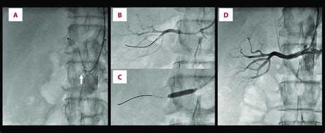 Percutaneous Transluminal Renal Angioplasty Procedure A Selective Download Scientific