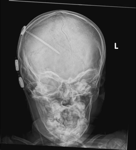 Normal Shunt Series Image