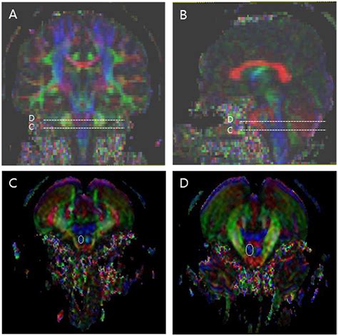 Frontiers Corticospinal Tract Integrity And Long Term Hand Function